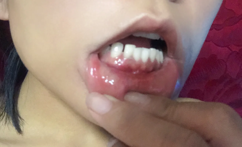 牙齦也會口腔潰瘍嗎-為什么牙齦會口腔潰瘍